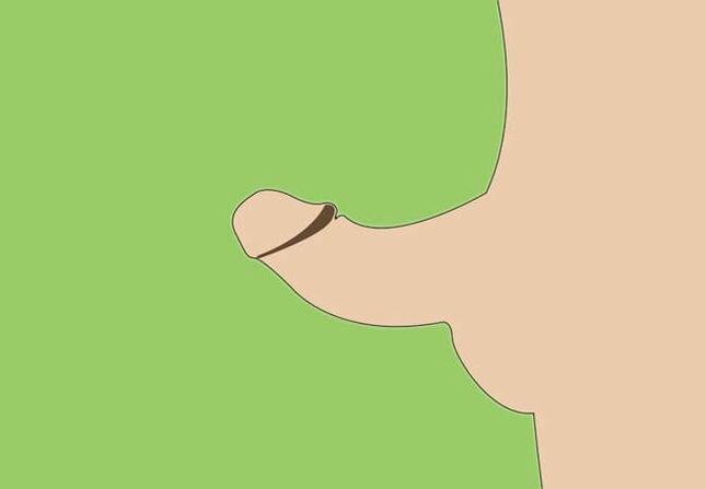 a pénisz görbülete a műtéti megnagyobbítás indikációjaként